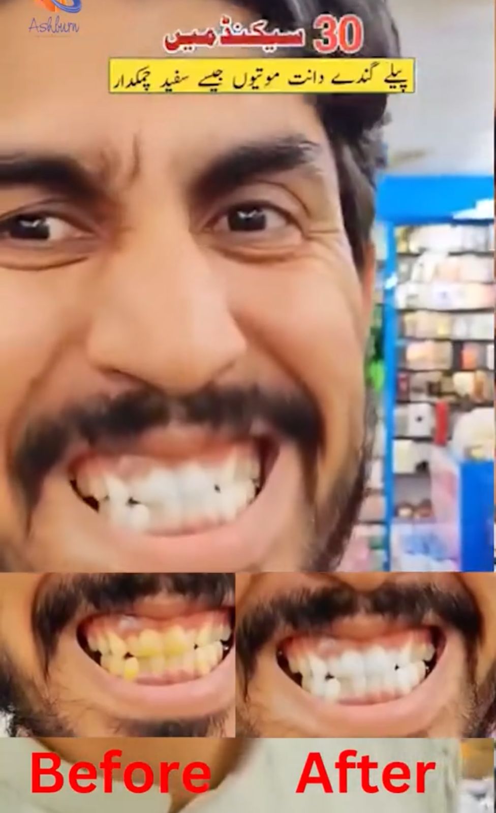 HISMILE V34 Teeth whitening 100%